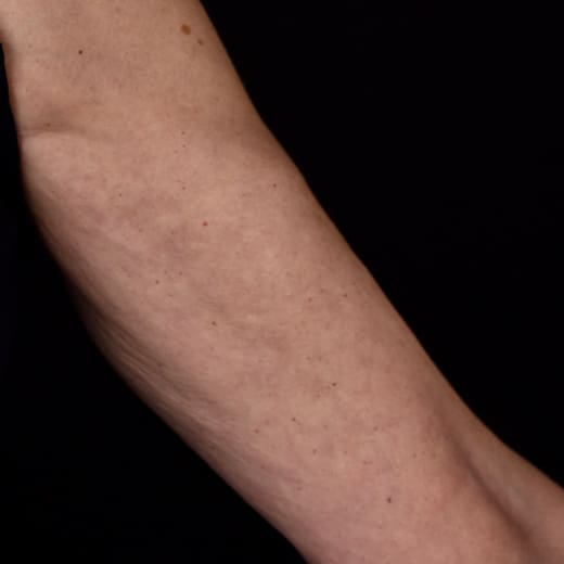 After BBL SkinTyte treatment, addressing sagging arms (bingo wings).
