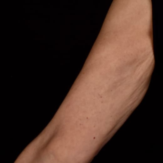 After BBL SkinTyte treatment, addressing sagging arms (bingo wings).