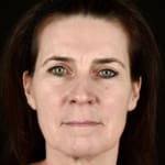 After BBL laser treatment, addressing rosacea.