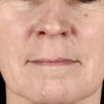 After BBL laser treatment, addressing rosacea.