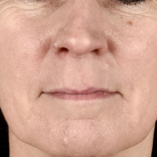 After BBL laser treatment, addressing rosacea.