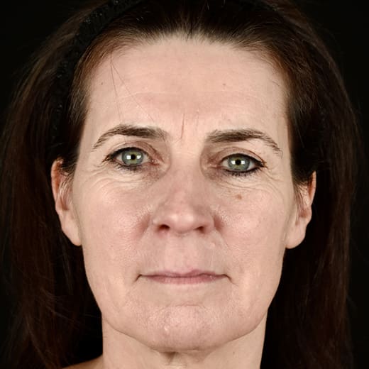 After BBL laser treatment, addressing rosacea.