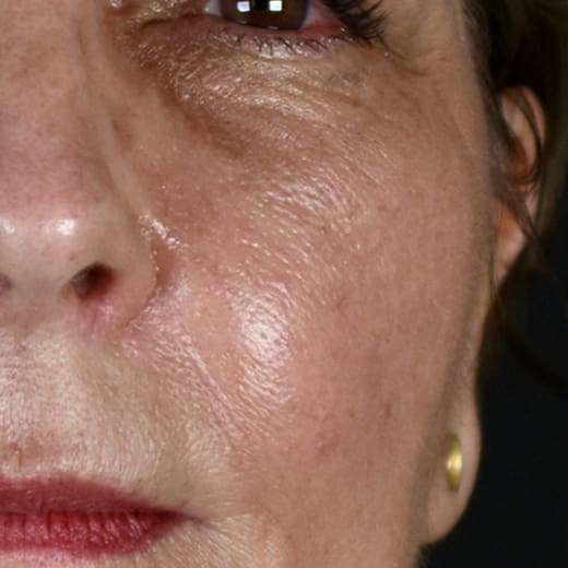 After BBL treatment, addressing redness and broken blood vessels.