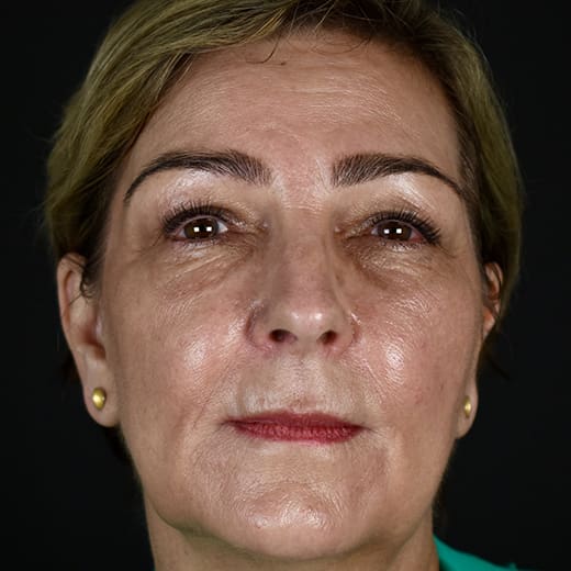 After BBL treatment, addressing redness and broken blood vessels.