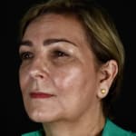 After BBL treatment, addressing redness and broken blood vessels.