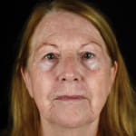 After BBL treatment, addressing rough skin and enlarged pores.