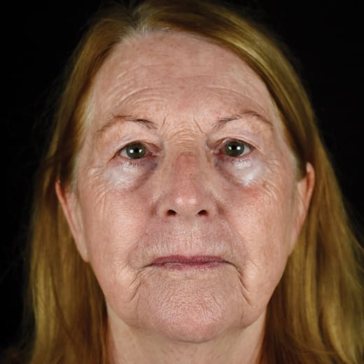 After BBL treatment, addressing rough skin and enlarged pores.