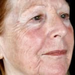 After BBL treatment, addressing rough skin and enlarged pores.