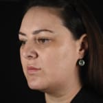 After BBL treatment, addressing sun damage, freckles, and lower cheek wrinkles.