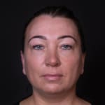 After cheek filler and wrinkle-relaxing injections, addressing sagging cheeks and frown lines.