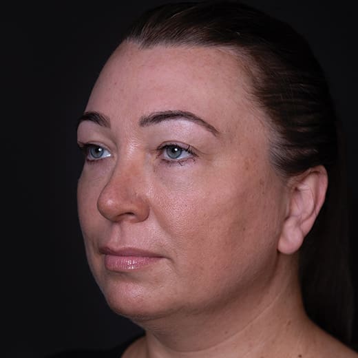 After cheek filler and wrinkle-relaxing injections, addressing sagging cheeks and frown lines.