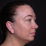 Before cheek filler and wrinkle-relaxing injections, addressing sagging cheeks and frown lines.