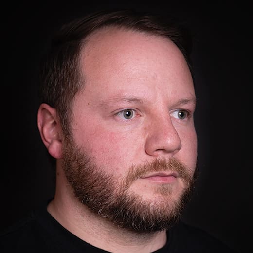 After cheek and tear trough filler, addressing signs of tiredness around the male eyes