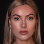 After chin and jaw filler with chin augmentation, addressing a deficient jawline.