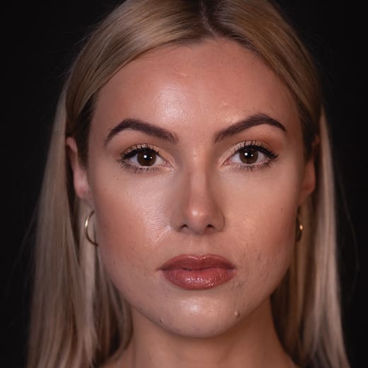 After chin and jaw filler with chin augmentation, addressing a deficient jawline.