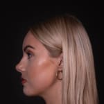 After chin and jaw filler with chin augmentation, addressing a deficient jawline.