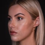 After chin and jaw filler with chin augmentation, addressing a deficient jawline.