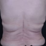 After CoolSculpting, addressing back fat and bra fat