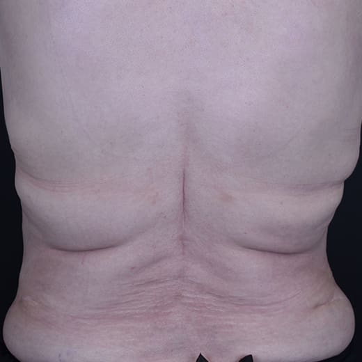 After CoolSculpting, addressing back fat and bra fat