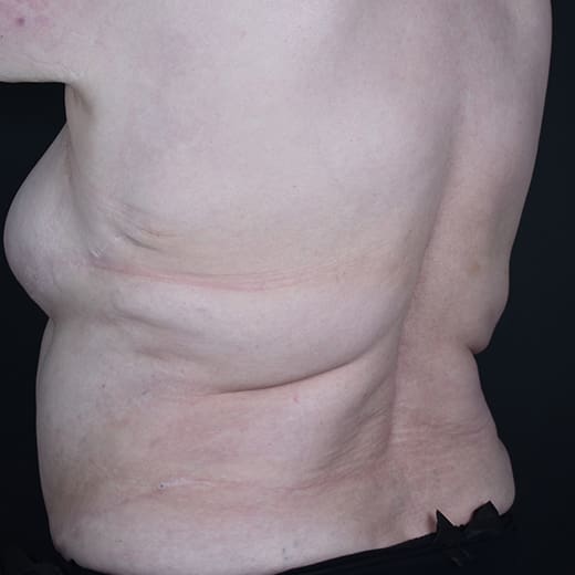 After CoolSculpting, addressing back fat and bra fat