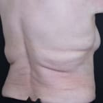 After CoolSculpting, addressing back fat and bra fat