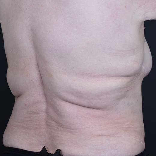 After CoolSculpting, addressing back fat and bra fat