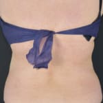 After CoolSculpting, addressing back fat and bra fat.