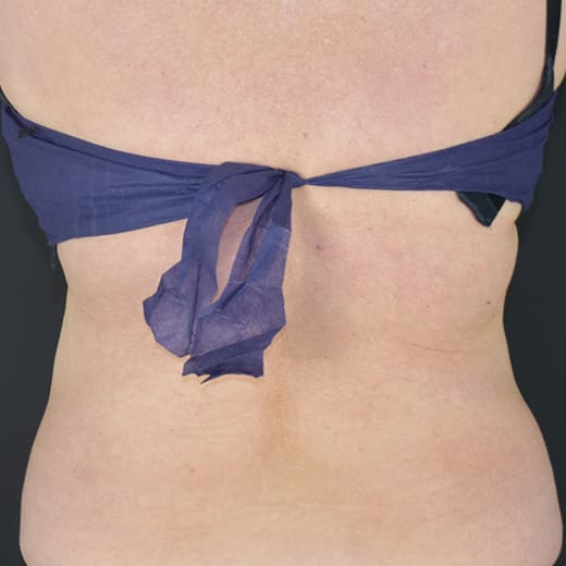 After CoolSculpting, addressing back fat and bra fat.