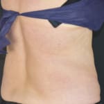 After CoolSculpting, addressing back fat and bra fat.