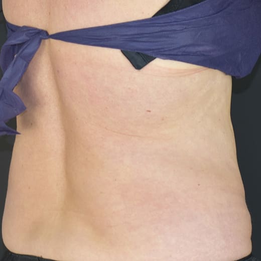 After CoolSculpting, addressing back fat and bra fat.