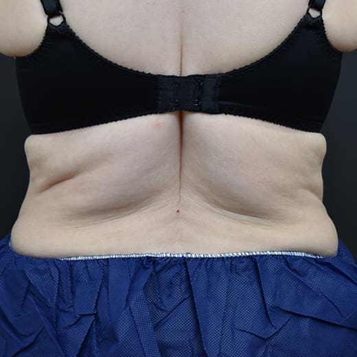 After CoolSculpting, addressing back fat and bra fat.