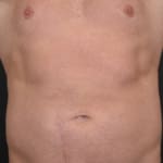 After CoolSculpting, addressing male belly fat (dad bod).