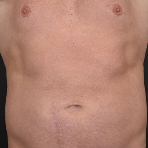 After CoolSculpting, addressing male belly fat (dad bod).