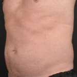 Before CoolSculpting, addressing male belly fat (dad bod).