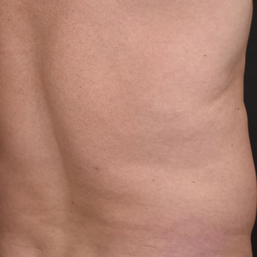 After CoolSculpting, addressing male belly fat (dad bod).