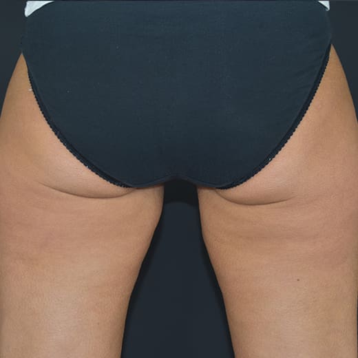 After CoolSculpting, addressing inner thighs and bum.