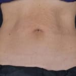 After CoolSculpting, addressing mummy tummy and belly fat.