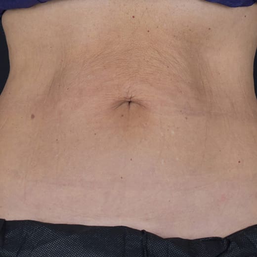 After CoolSculpting, addressing mummy tummy and belly fat.