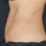 After CoolSculpting, addressing mummy tummy and belly fat.