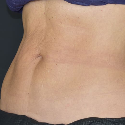 After CoolSculpting, addressing mummy tummy and belly fat.