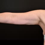 After CoolSculpting, addressing sagging arms (bingo wings).