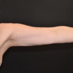 After CoolSculpting, addressing sagging arms (bingo wings).