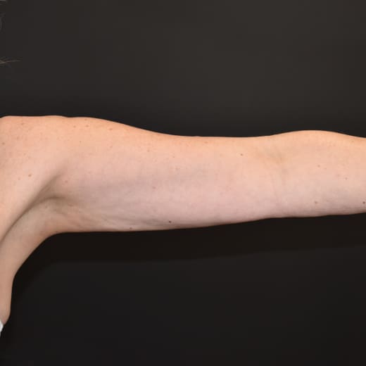 After CoolSculpting, addressing sagging arms (bingo wings).
