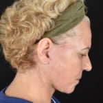 After deep plane face and neck lift with jowl lift, addressing jowls, sagging neck, and sagging jawline