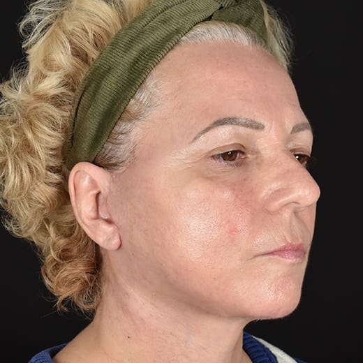 After deep plane face and neck lift with jowl lift, addressing jowls, sagging neck, and sagging jawline