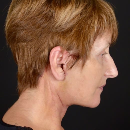 After deep plane facelift and neck lift, addressing sagging neck and jawline.