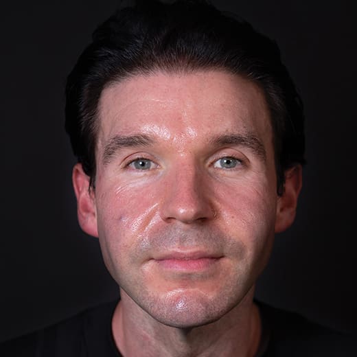 After dermal fillers, addressing sagging cheeks and jawline in the male face