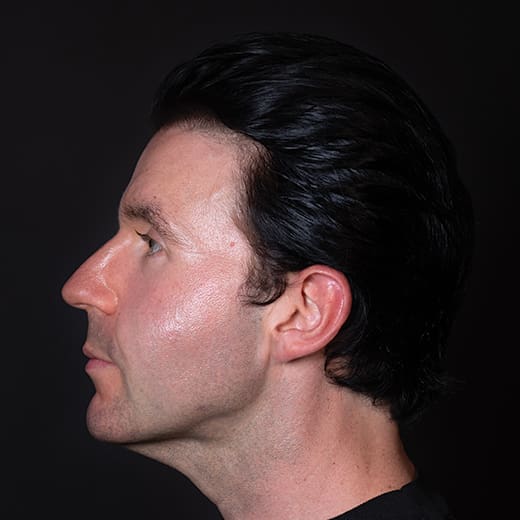 After dermal fillers, addressing sagging cheeks and jawline in the male face
