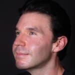 After dermal fillers, addressing sagging cheeks and jawline in the male face