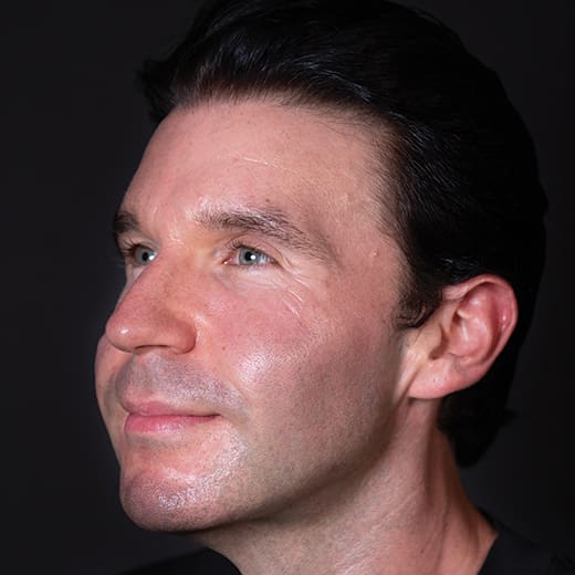 After dermal fillers, addressing sagging cheeks and jawline in the male face
